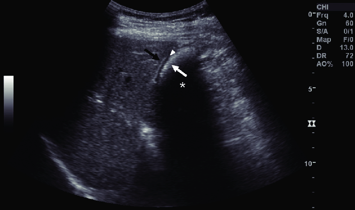 https://www.researchgate.net/publication/346542956/figure/fig9/AS:990512395874304@1613167966342/Gallstone-with-wall-echo-shadow-sign-Ultrasound-shows-a-typical-wall-echo-shadow-sign.png