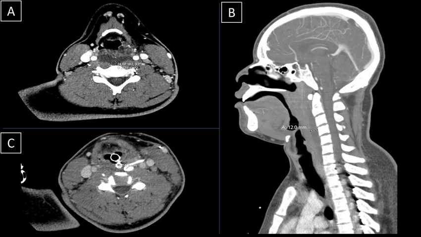 CT Angiogram Head and Neck with and without contrast on 7/21 compared to CT Soft Tissue Neck with and without contrast on 7/24. A, At presentation 7/21 axial view of edematous appearance of the bilateral palatine tonsils and suppurative left retropharyngeal lymph node. Partial effacement of the oropharynx secondary to tonsillar edema. B, At presentation 7/21 sagittal view findings of pharyngitis/tonsillitis, with retropharyngeal effusion extending from the level of C2 to C3 to C7-T1 with maximum thickness of 12 mm. Multiple enlarged retropharyngeal, cervical, and supraclavicular lymph nodes, likely reactive. C, Interval 3-day follow-up 7/24 status post I & D with decreased retropharyngeal fluid collection now measuring approximately 5 mm thickness. CT indicates computed tomography; I & D, incision and drainage.