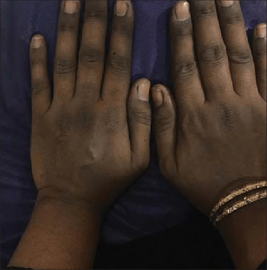 Hyperpigmentation On The Back Of The Hands Download Scientific Diagram