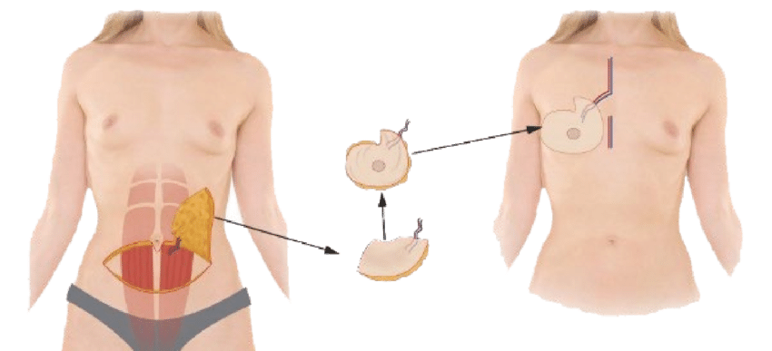 Key anatomical landmarks for DieP flap breast neurotization with
