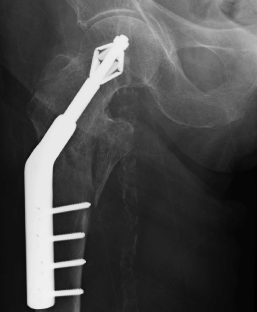 Anteroposterior Radiograph Of X Bolt Dynamic Hip Plating System
