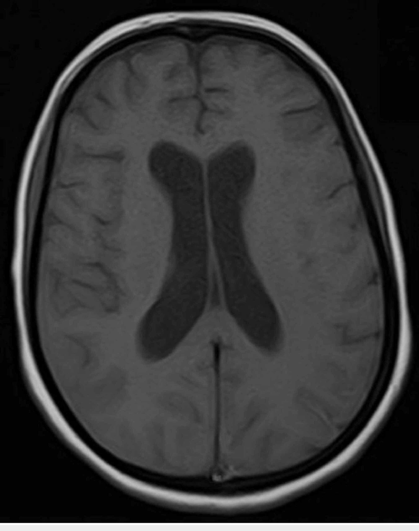 Axial image of the brain after 10 days of hospital admission showing ...