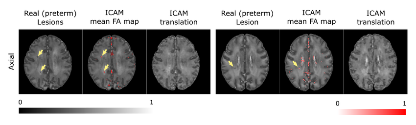 Dhcp Results Here We Show Detection Of Punctate White Matter Lesions