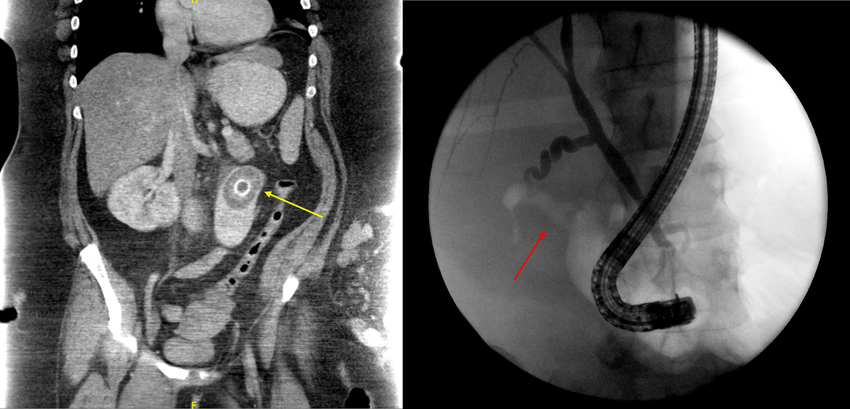 Left Abdominal Ct Scan Showing Impacted Gallstone In Bowel Lumen