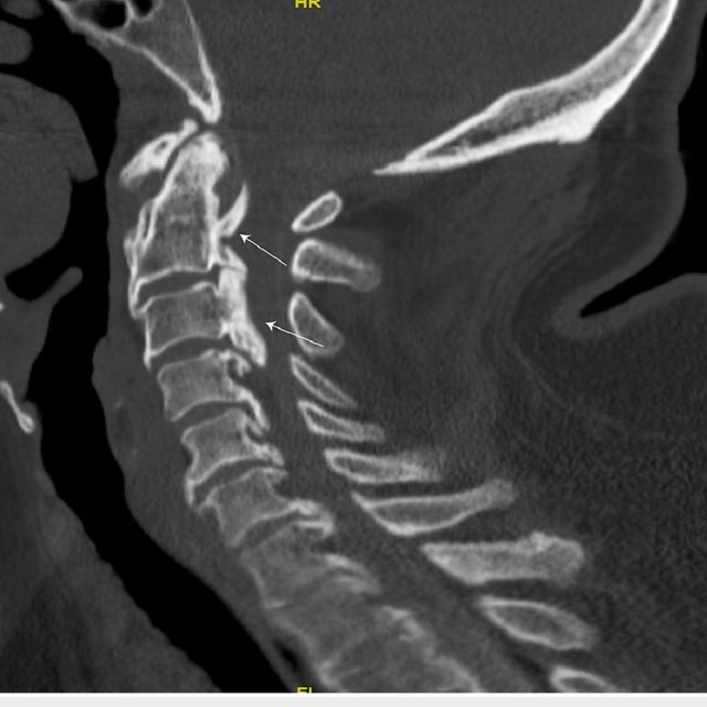 Sagittal Ct Myelogram Demonstrating Opll From C2 5 In The Cervical