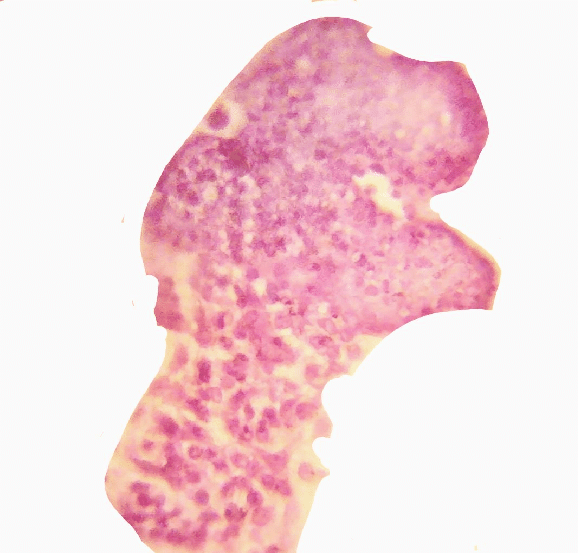 Microscopic picture of decidual cast with infiltration of decidua
