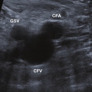 Transverse ultrasound image of the common femoral artery (CFA) and vein ...