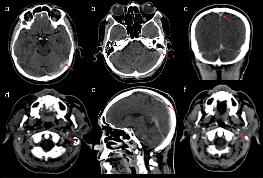 Radiological finding. a, b The axial view of noncontrast CT scan brain ...