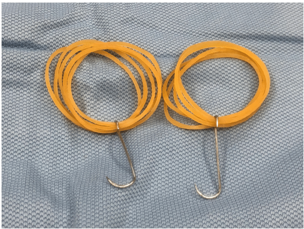 Fish hook retractor used for scalp traction in cranial surgery.