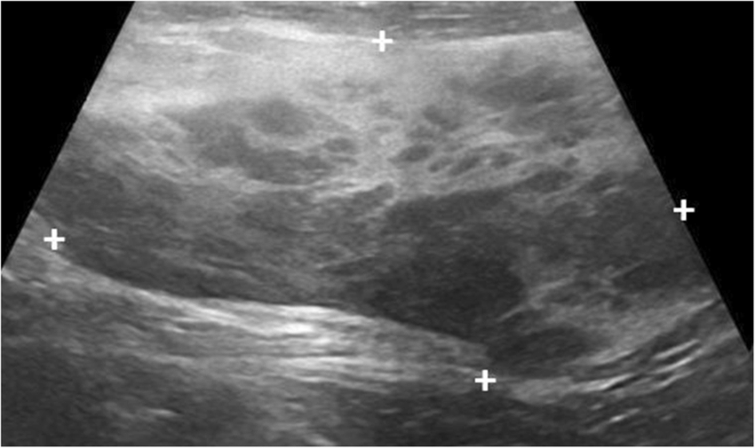 Mini-puberty of infancy in a 16-month-old girl with prominent breast