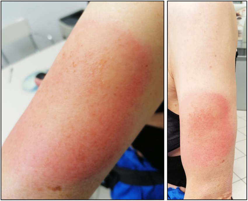 a) Day 1, patient presents with flat erythematous rash with scattered