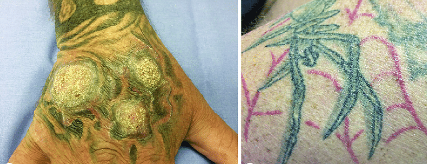 Delayed-type hypersensitivity reaction to red tattoo ink. a