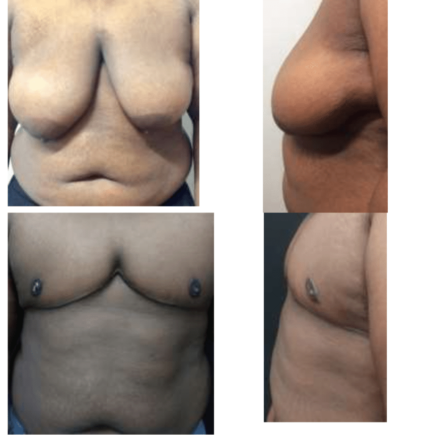 22-year-old FtM patient with a BMI of 40.62 kg/m 2 and D cup
