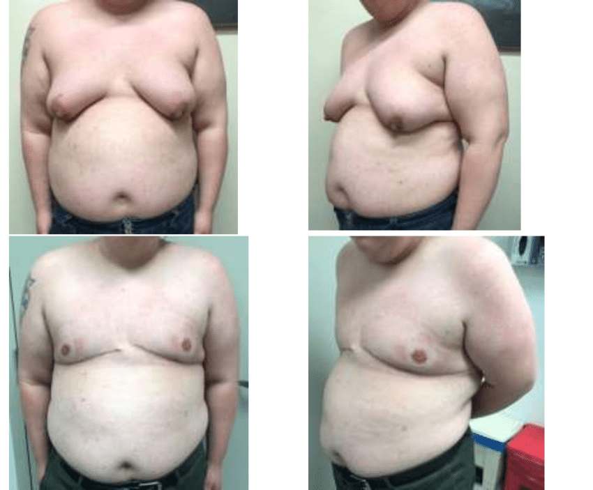 27-year-old FtM patient with a BMI of 40.31 kg/m 2 and C cup