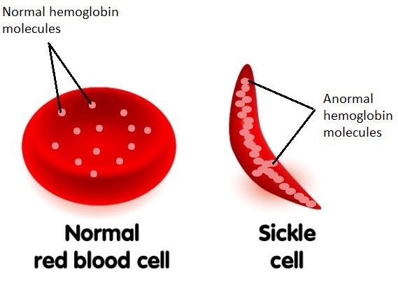 https://www.researchgate.net/publication/353614471/figure/fig2/AS:1051845086703618@1627790819636/Shape-of-Sickle-cell-with-abnormal-hemoglobin.jpg