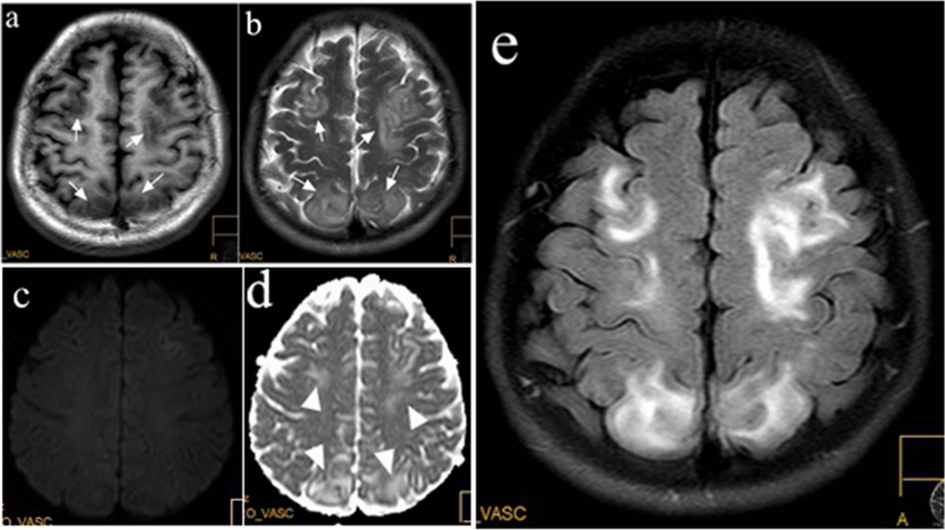 The imaging features of a 32-year-old PE patient with PRES. Lesions ...