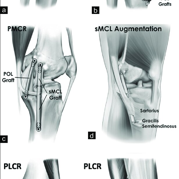 Reconstruction techniques used for multiligament knee reconstruction ...