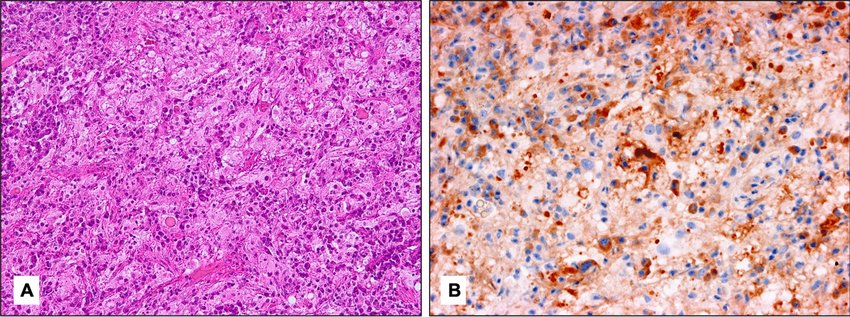 A Histopathology Of A Patient With Rosai Dorfman Disease Rdd With