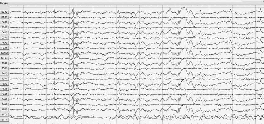 Patient 1, 12 years old. Fragment of electroencephalogram. Epileptiform ...