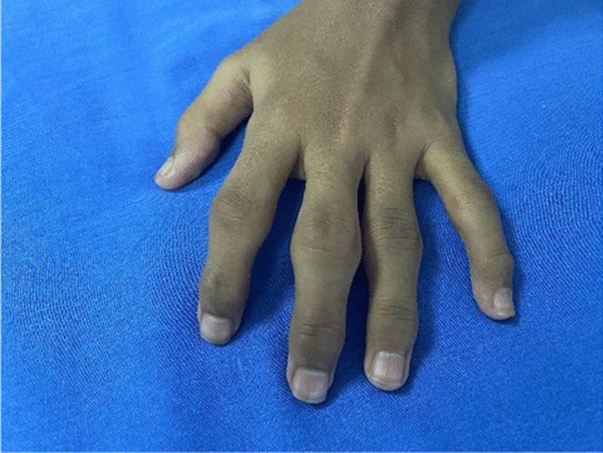 Swelling Of The Proximal Distal Interphalangeal Joints Of The Left Hand