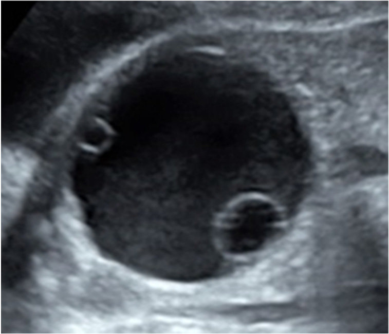 Ovarian Daughter Cyst Ultrasound