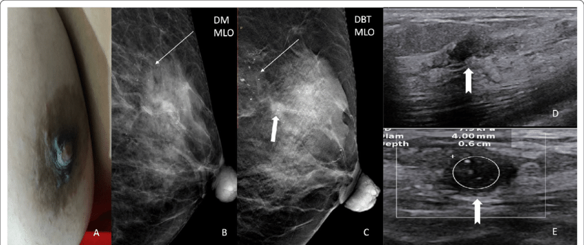 A 60-year-old patient complained of itching in her left breast (A). DM