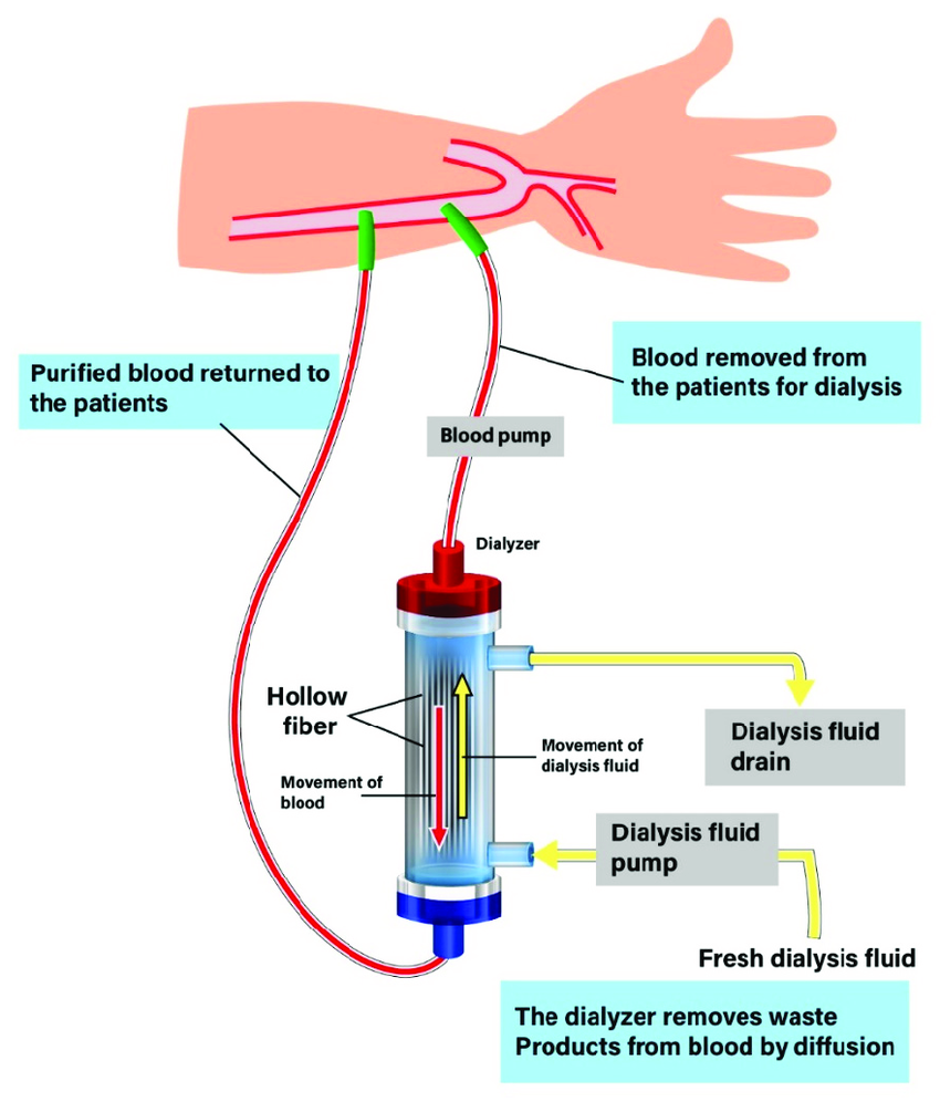 the-procedure-of-hemodialysis-a-patient-is-connected-to-a-dialysis