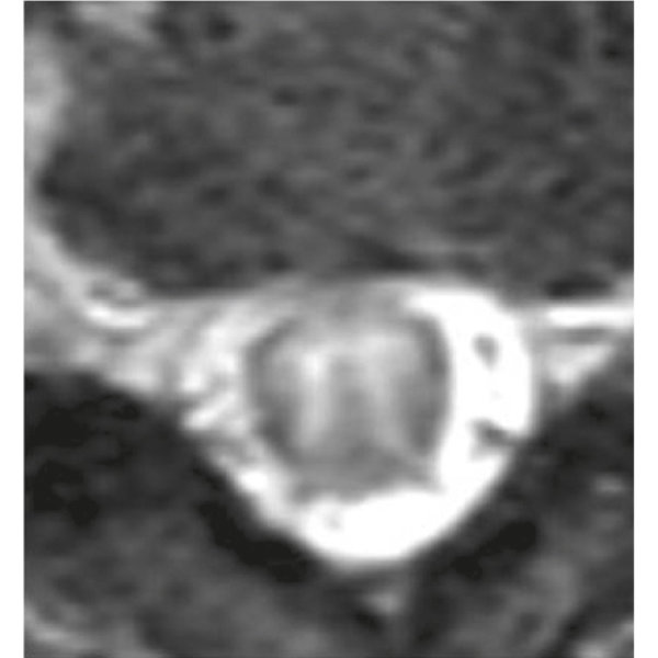 (a) MRI cervical spine sagittal STIR. Longitudinally extensive T2 ...