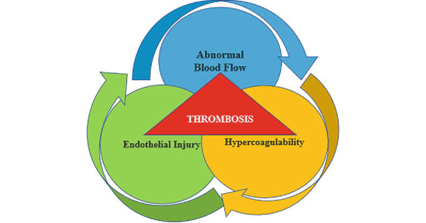 Mechanisms Of Virchow Triad In The Pathophysiology Of Thrombus