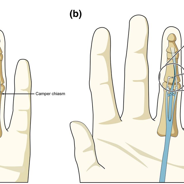 Reconstruction of the central slip insertion of the extensor tendon ...
