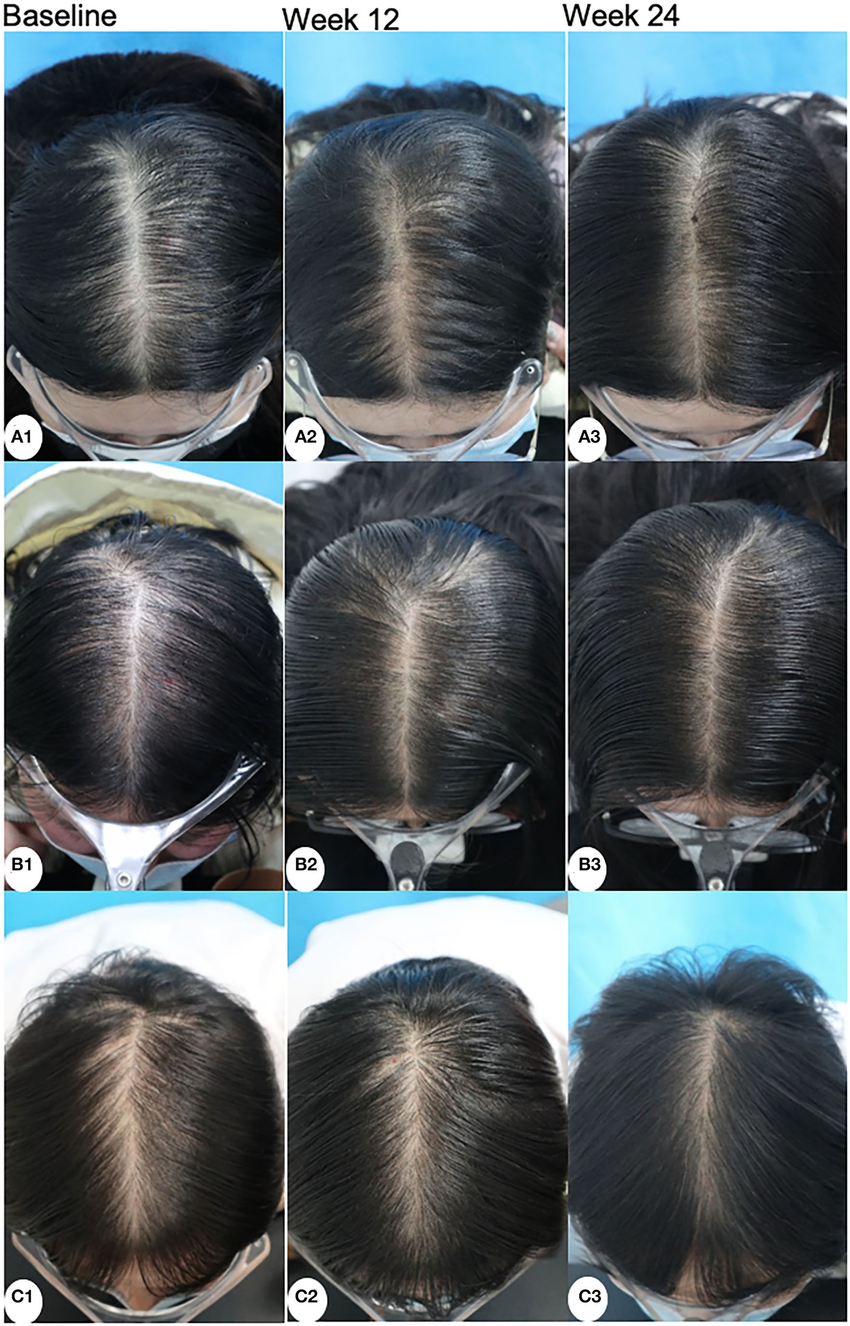 photographs of patients with minoxidil (A),... | Download Scientific