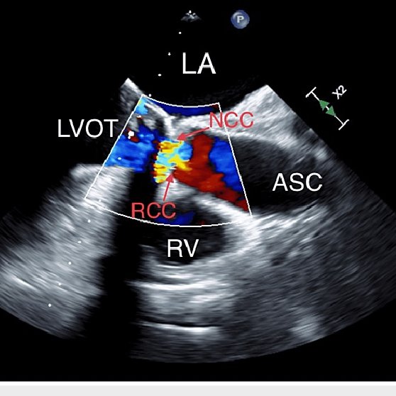 Mid Esophageal Tee Aortic Valve Short Axis View Showing Aortic