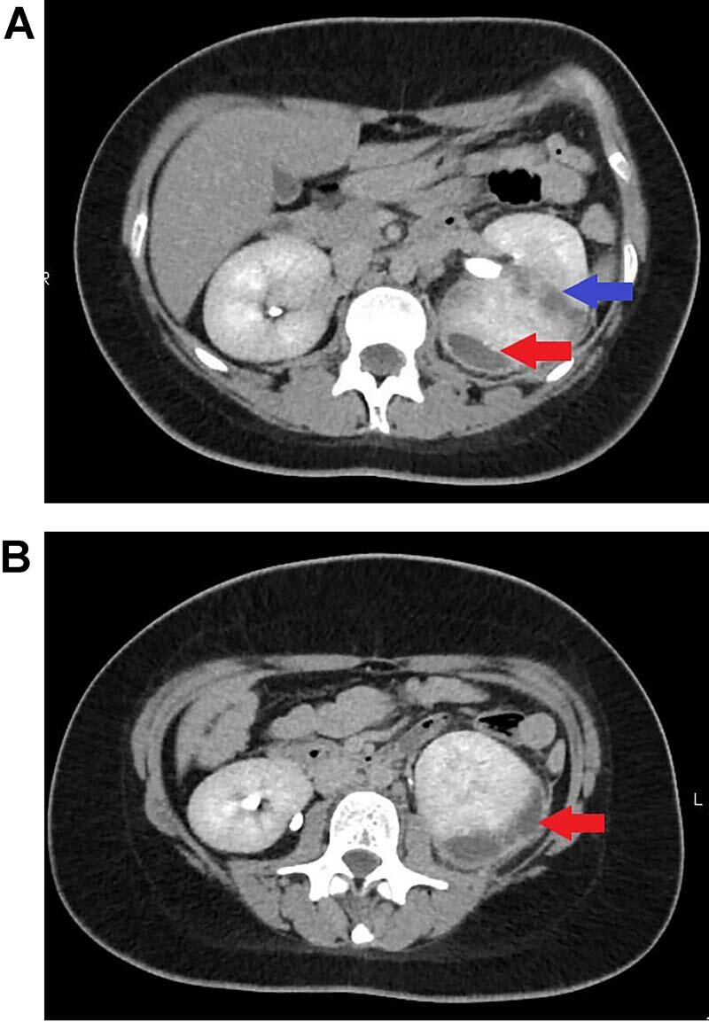 A Renal Ct Scan Showing An Abscess In The Left Kidney Blue Arrow