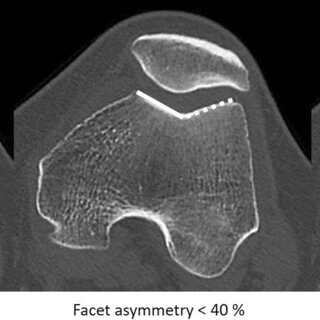 Medium-sized dense breast: a representative MR slices; b BCFCM outputs;