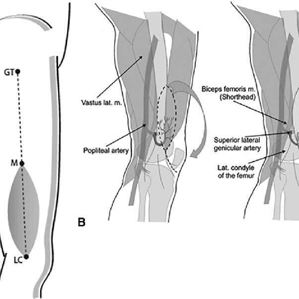 Photographic records of the superior lateral genicular flap (A) and ...
