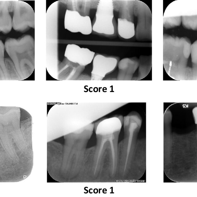 Example of scores 0, 1, and 2 on bitewing and periapical radiographs ...
