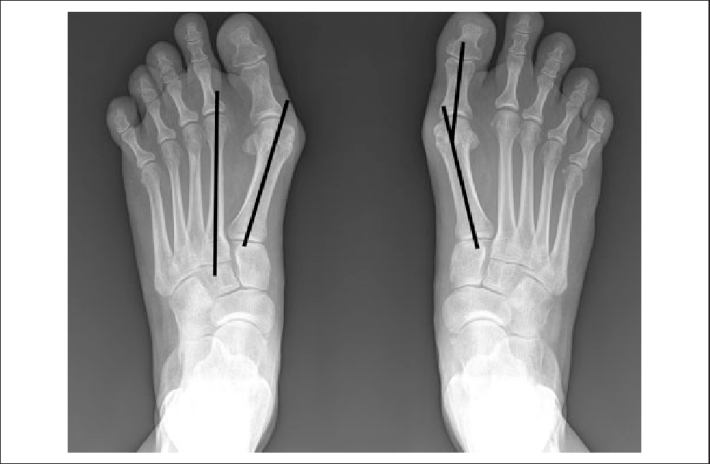 Anteroposterior weight-bearing feet radiograph. Intermetatarsal angle ...