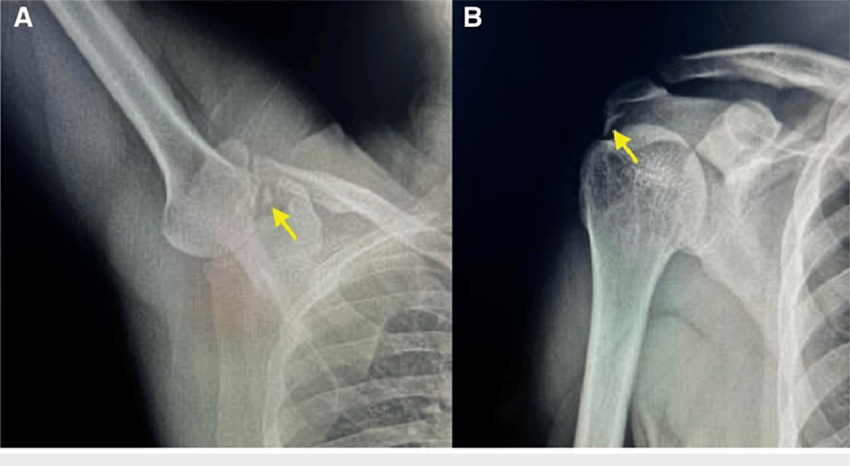 Right shoulder radiographs (A) axillary view showing calcific