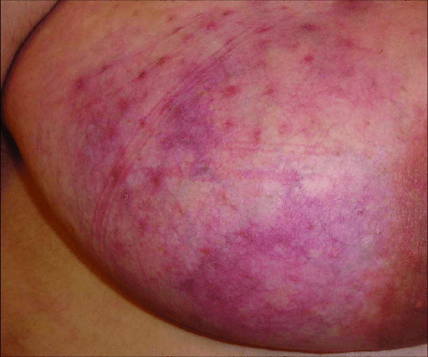 Breast rash 