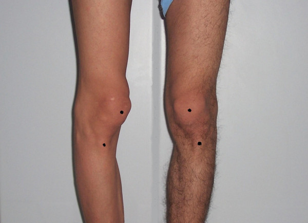The Knee Resource  Patellar Dislocation & Subluxation