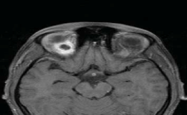 D Post Gadolinium Contrast Enhanced Axial T1 Weighted Mri Reveals