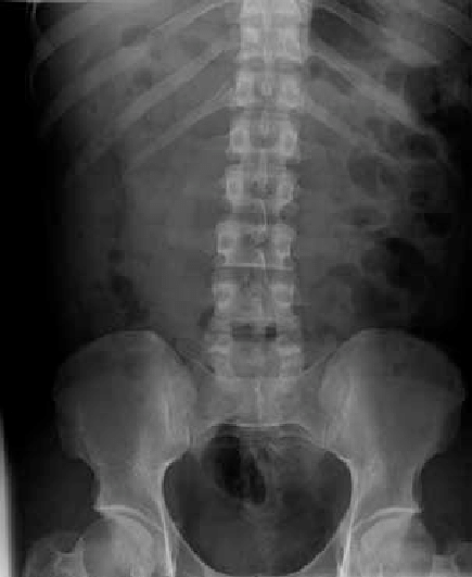 Control abdominal X-ray after passage of three stools without packets