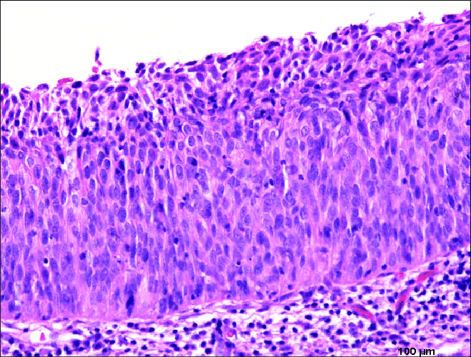 Cervical Squamous Intraepithelial Lesion | Hot Sex Picture