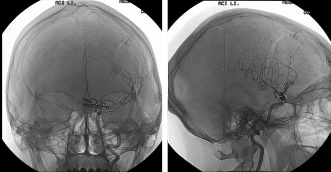 Post-operative DSA images ((A) AP view; (B) lateral view) demonstrating ...