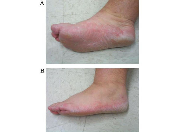 Bilateral moccasin type tinea pedis lesions. Moccasin type tinea